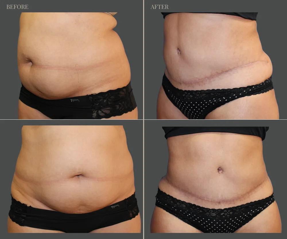 Tummy Tuck Before & After result 5