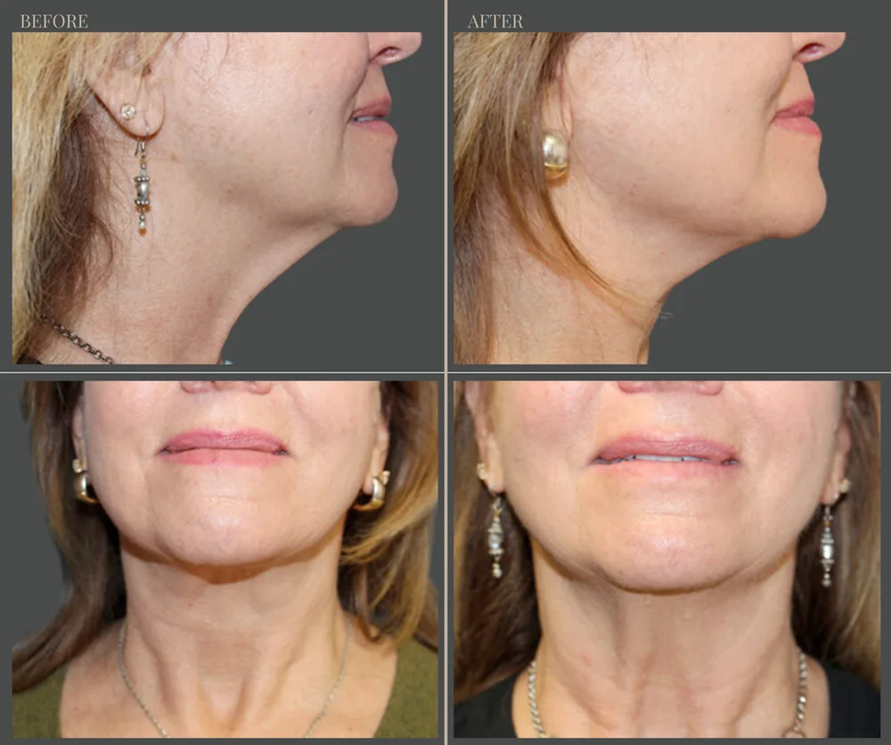 Neck Lift Before & After result 5