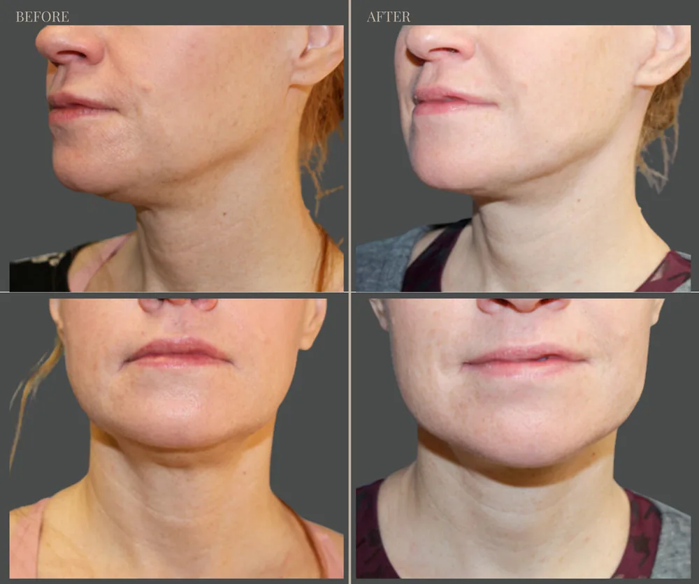 NECK LIFT before-and-after result 3