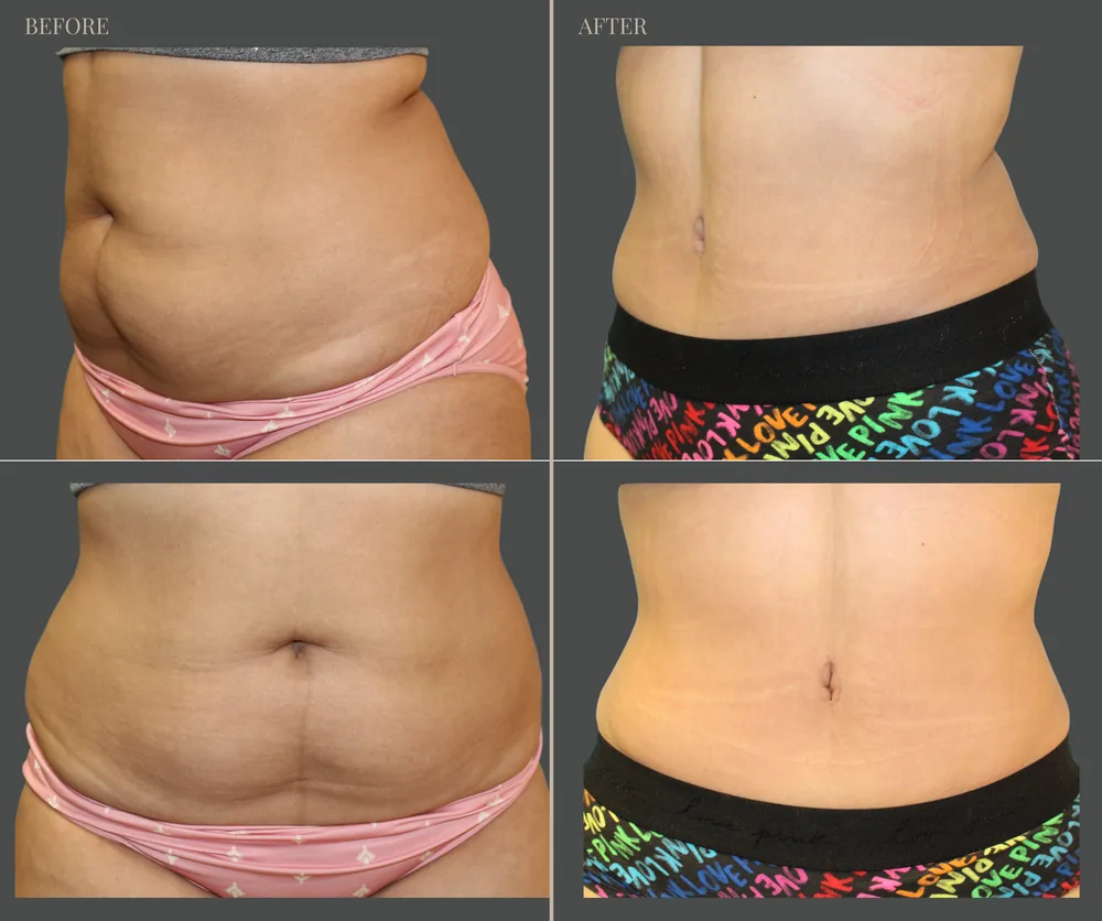 Tummy Tuck before-and-after result 3