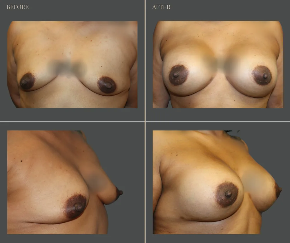 Breast Augmentation Before & After result 28