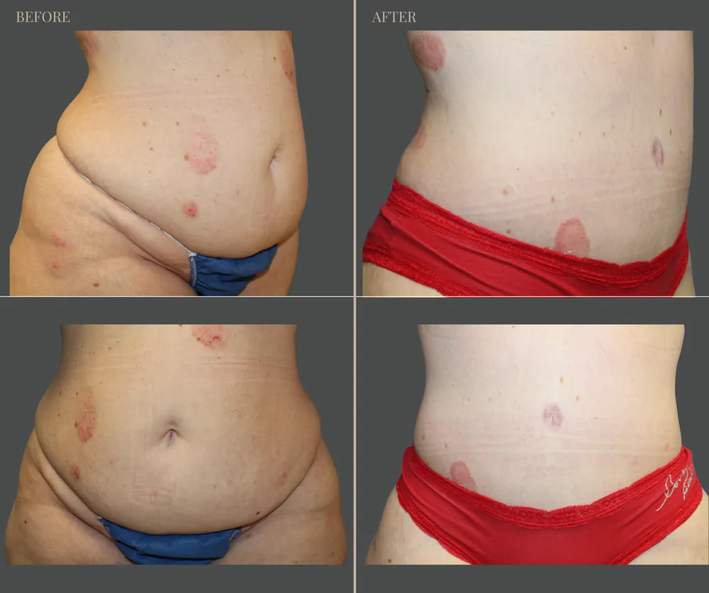 Tummy Tuck Before & After result 14