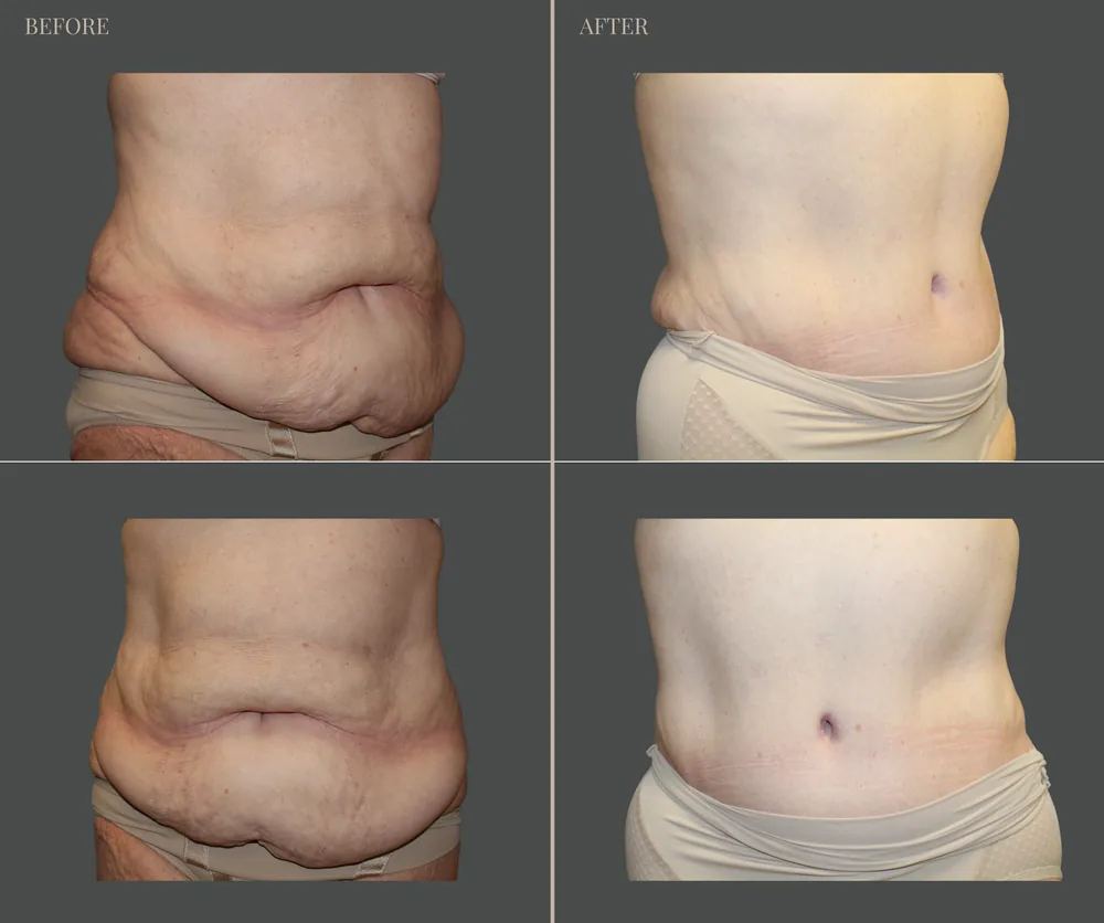 Tummy Tuck Before & After result 39