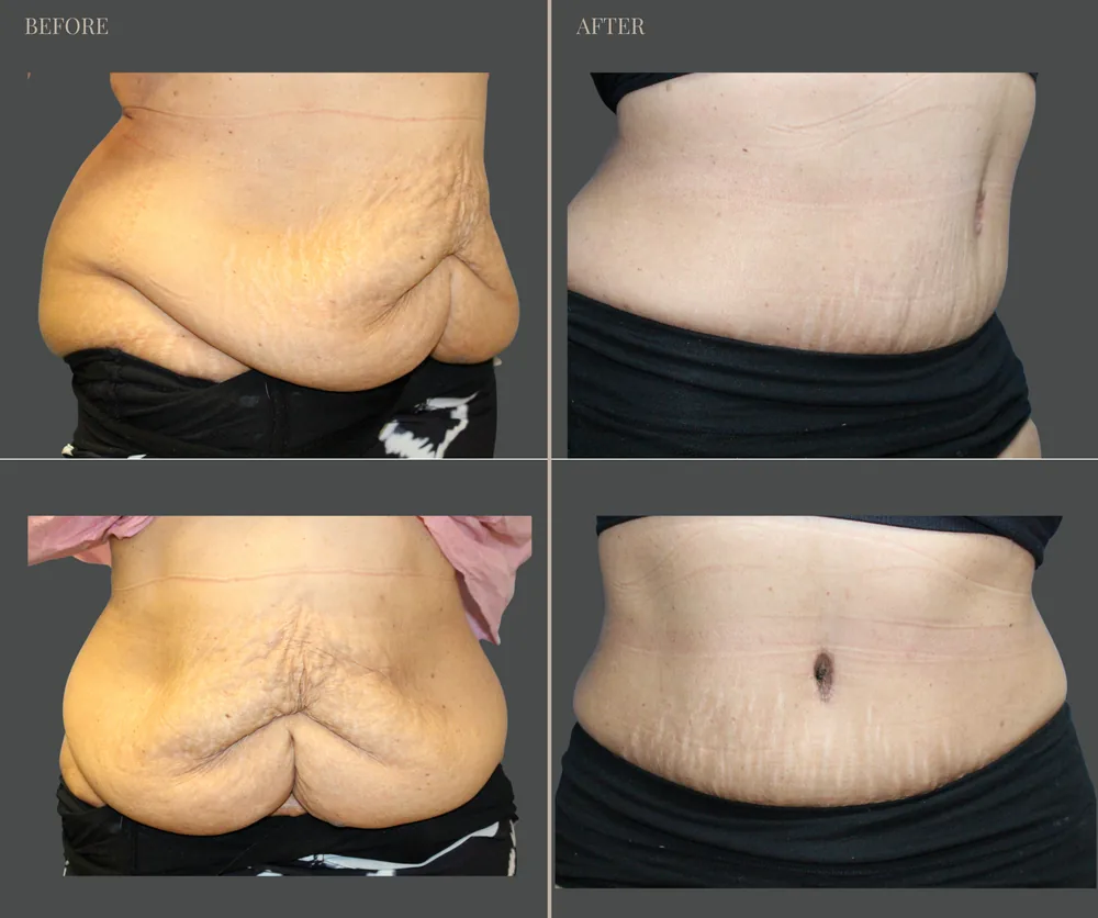 Tummy Tuck Before & After result 40