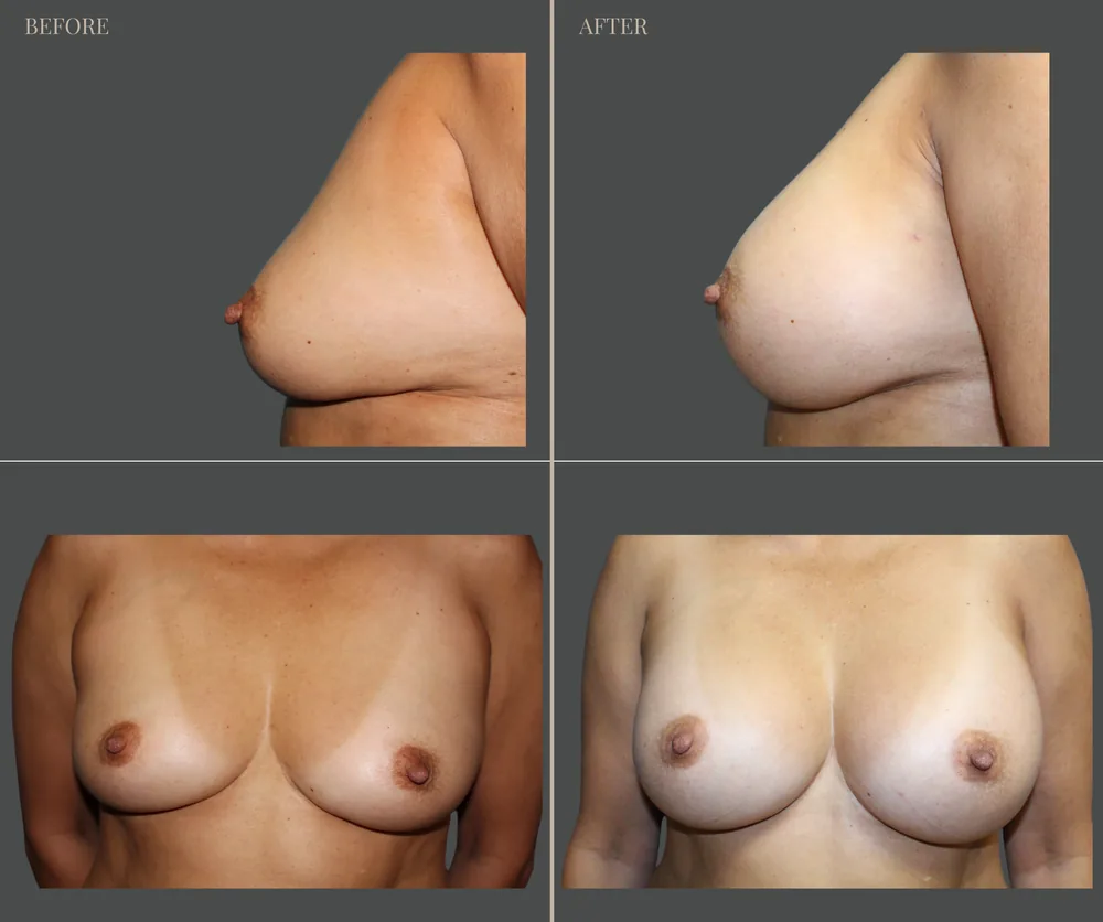 BREAST AUGMENTATION before-and-after result 2
