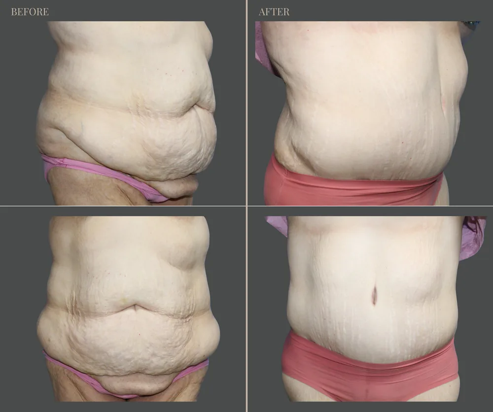 Tummy Tuck Before & After result 18