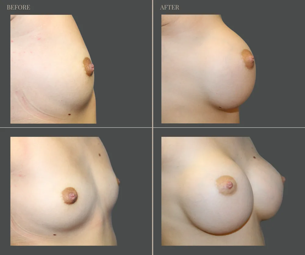 Breast Augmentation Before & After result 16