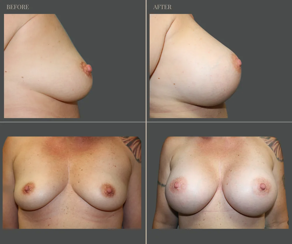 Breast Augmentation Before & After result 30