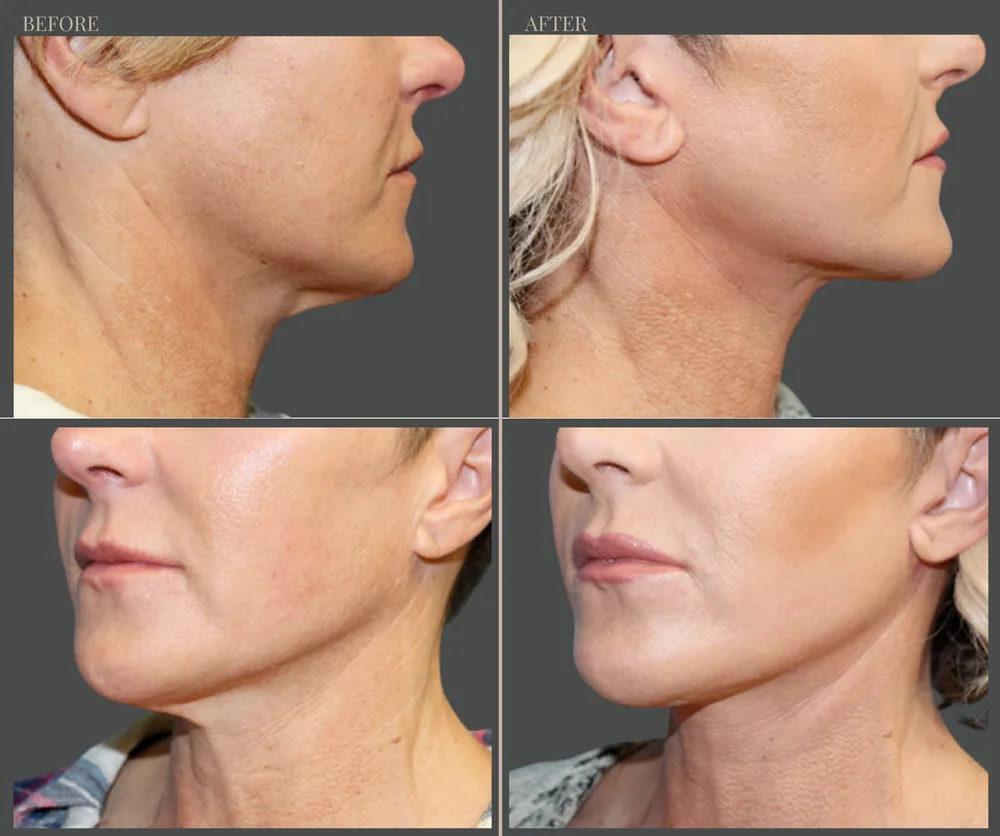 NECK LIFT before-and-after result 1