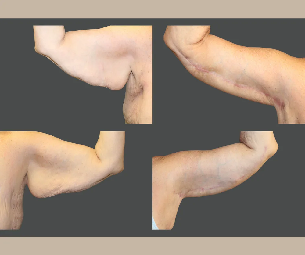 Arm Lift Before & After result 9