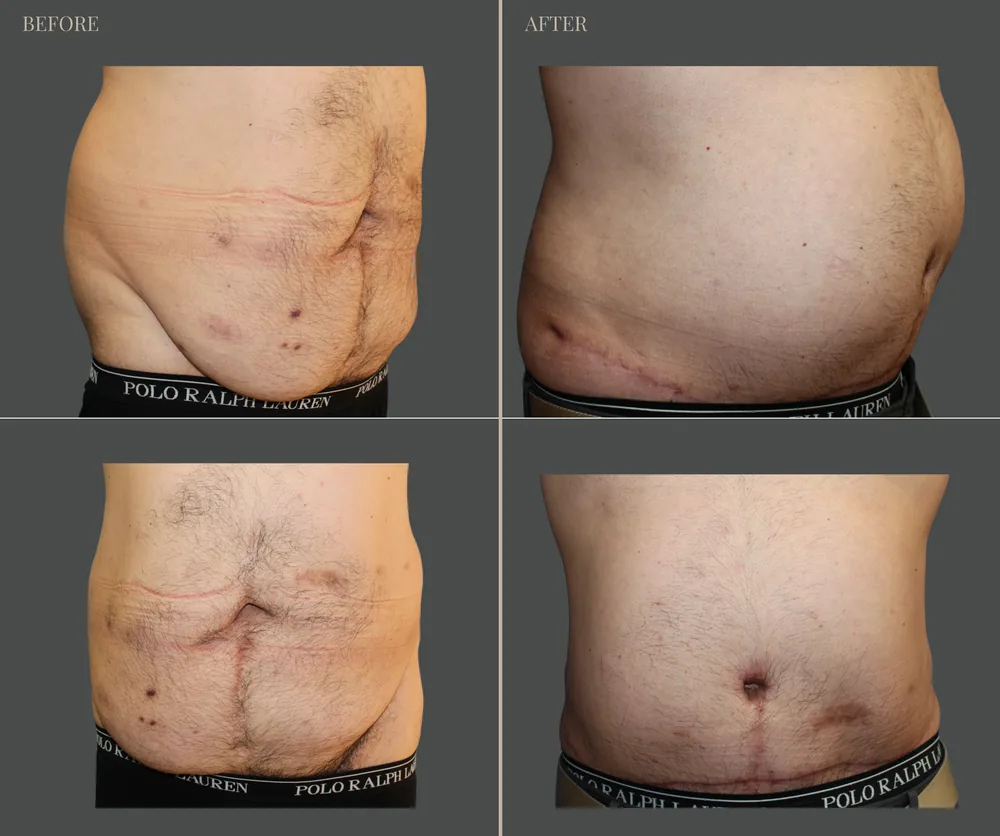 Tummy Tuck Before & After result 26