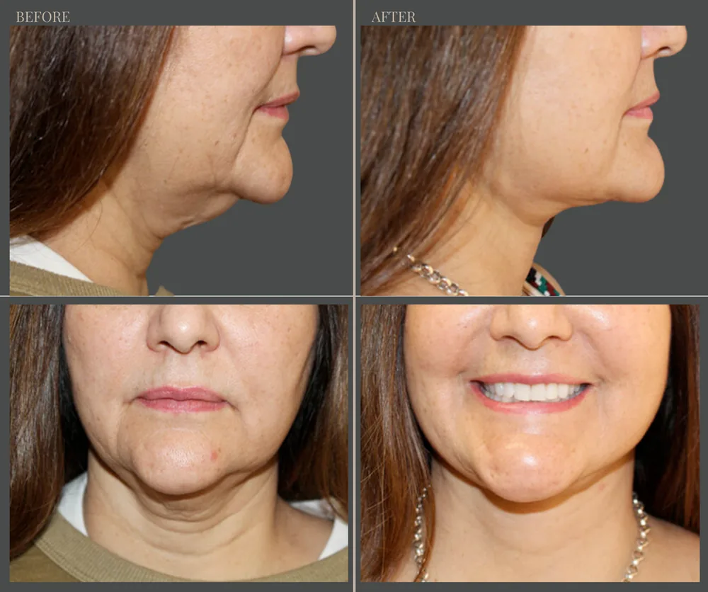 NECK LIFT before-and-after result 2