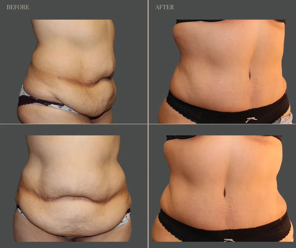 Tummy Tuck Before & After result 19