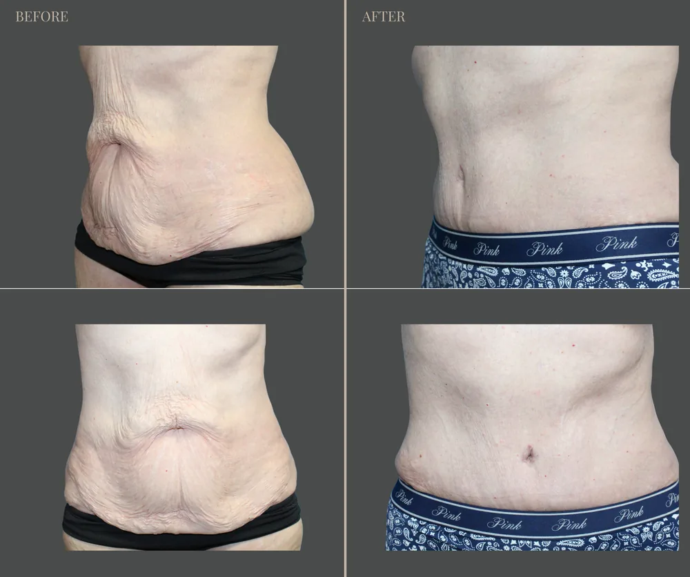Tummy Tuck Before & After result 37