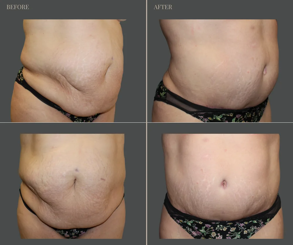Tummy Tuck Before & After result 21