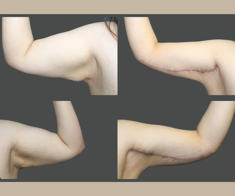 Arm Lift Before & After result 6