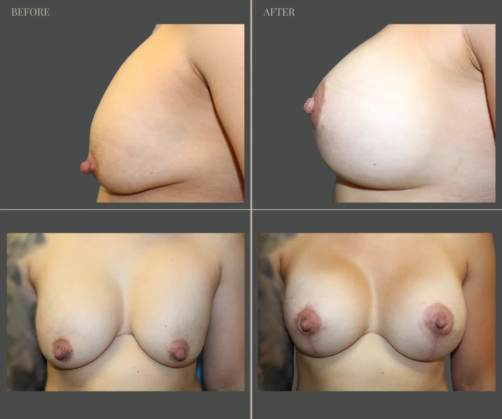 Breast Augmentation Before & After result 26