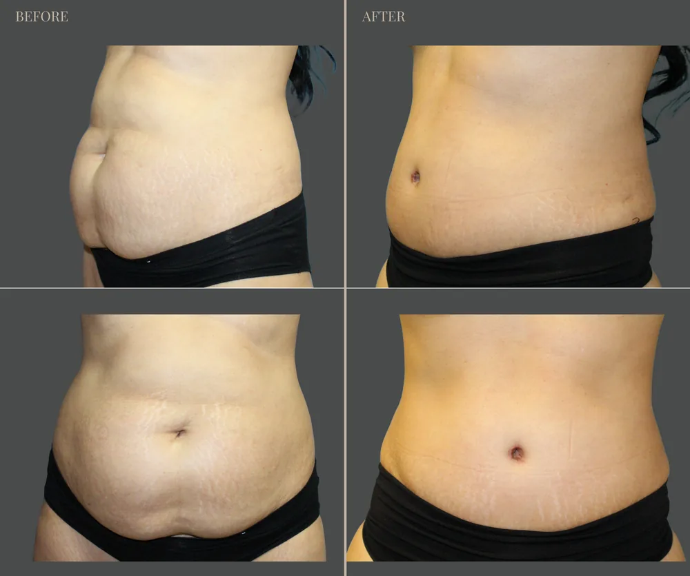 Tummy Tuck Before & After result 17