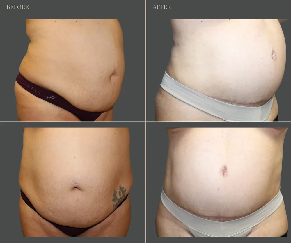 Tummy Tuck Before & After result 16