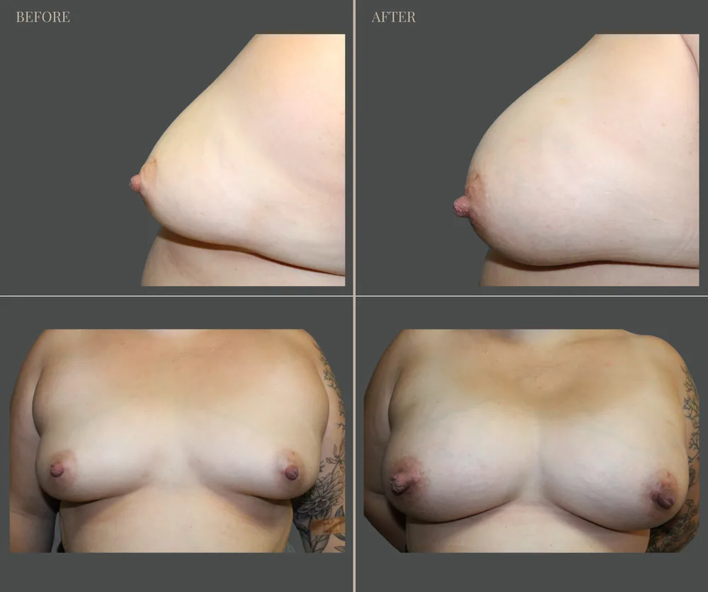Breast Augmentation Before & After result 25
