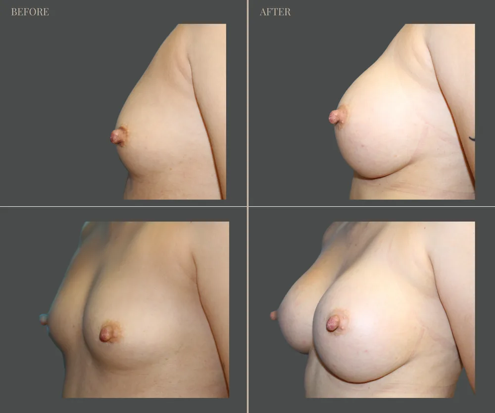 Breast Augmentation Before & After result 9