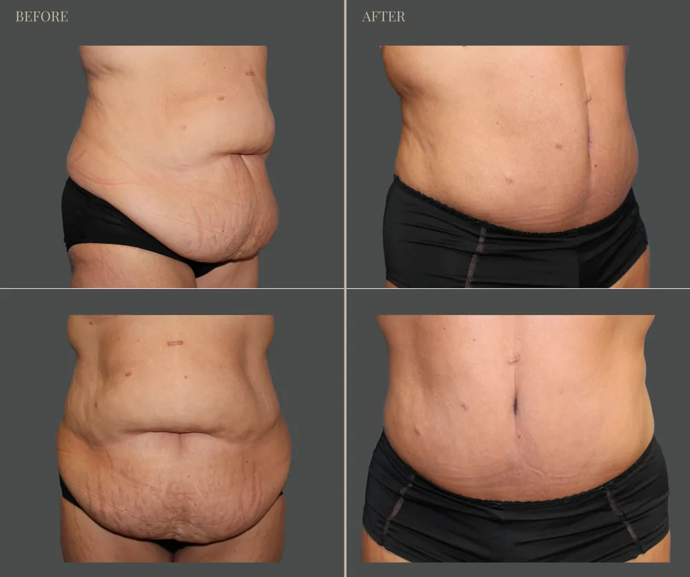 Tummy Tuck Before & After result 25