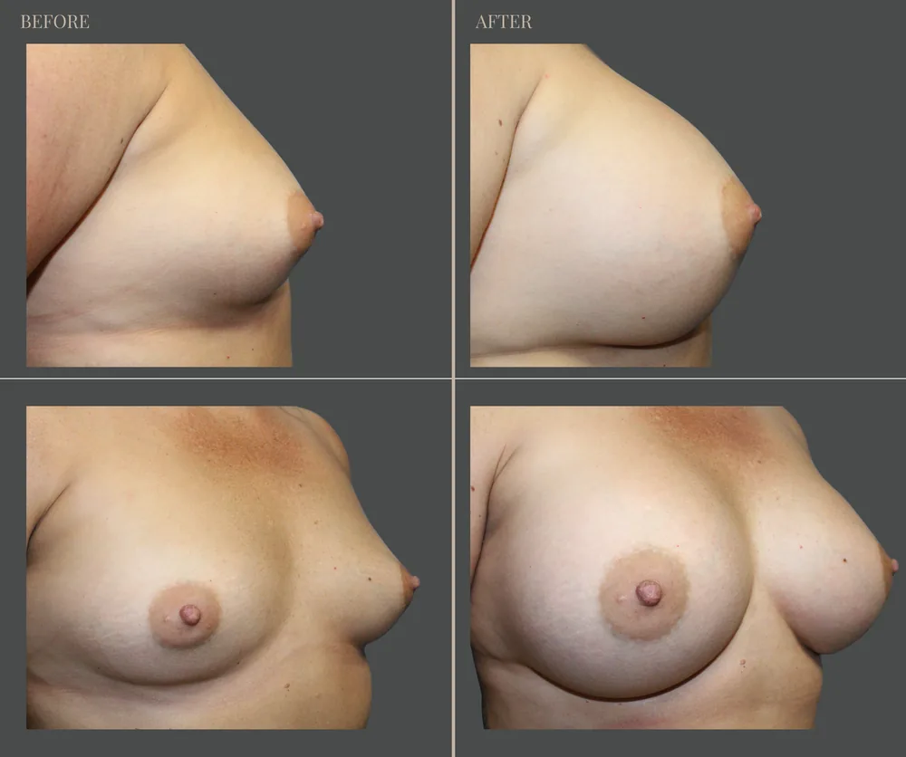 Breast Augmentation Before & After result 32