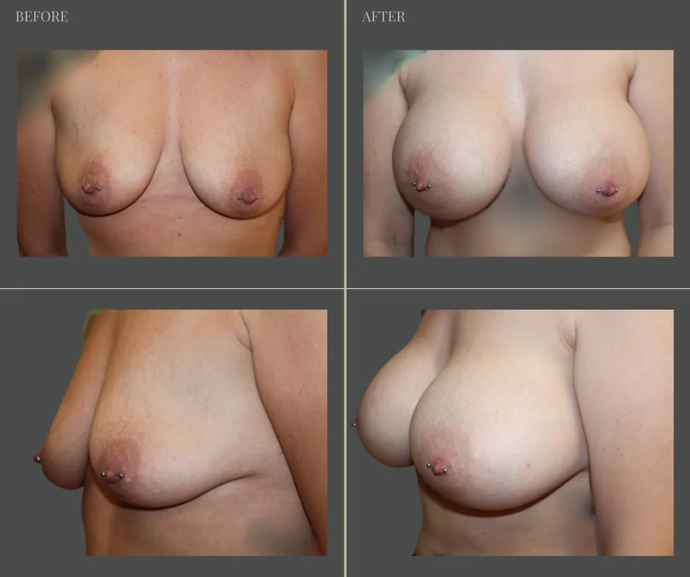 Breast Augmentation Before & After result 31