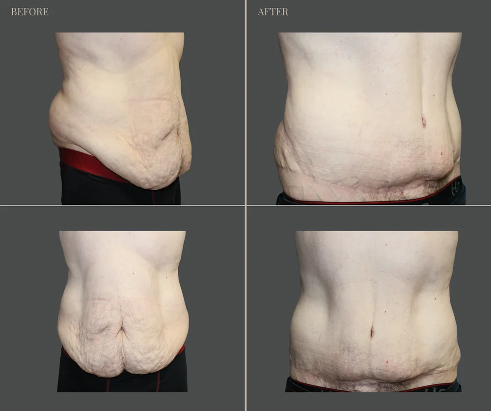Tummy Tuck Before & After result 31