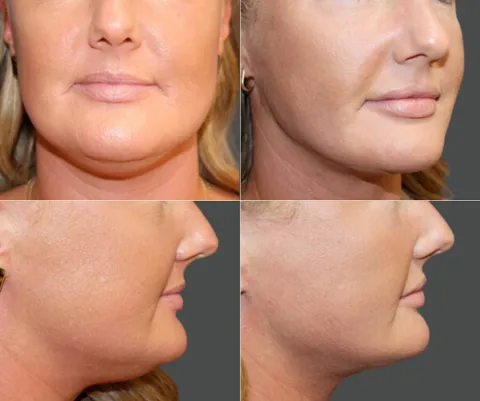 Results preview for liposuction face neck