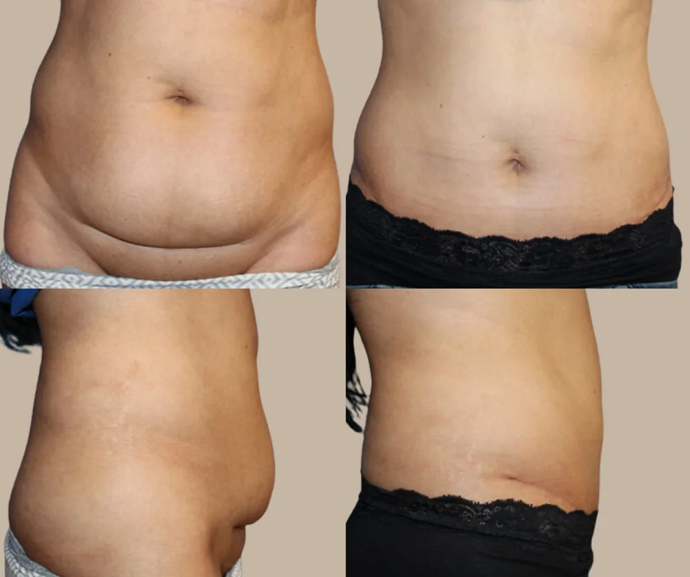 Mini Tummy Tuck Before & After result 4