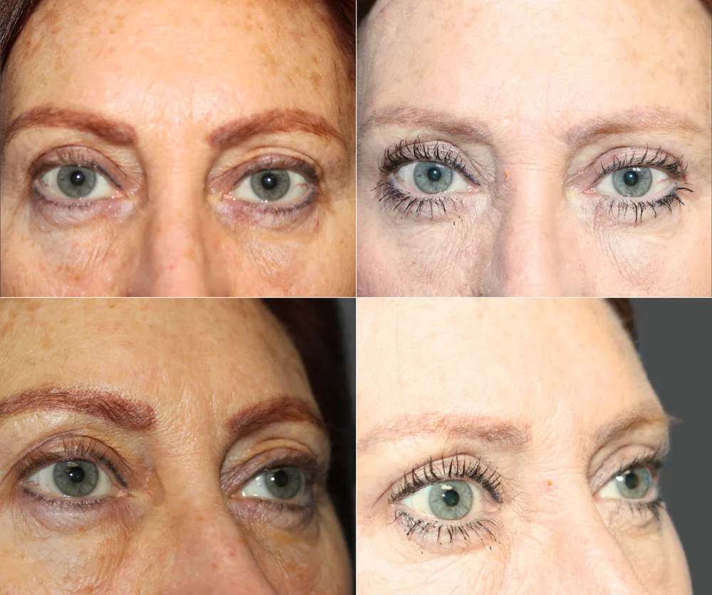 Eyelid Surgery Before & After result 11