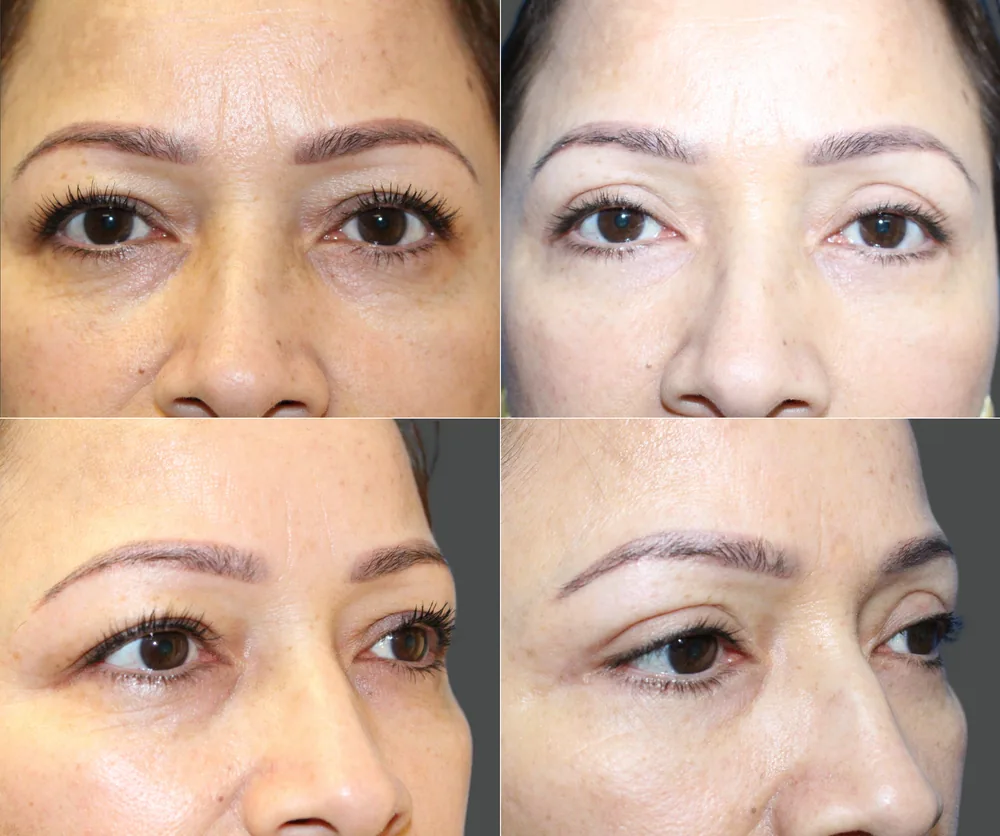 Eyelid Surgery Before & After result 12