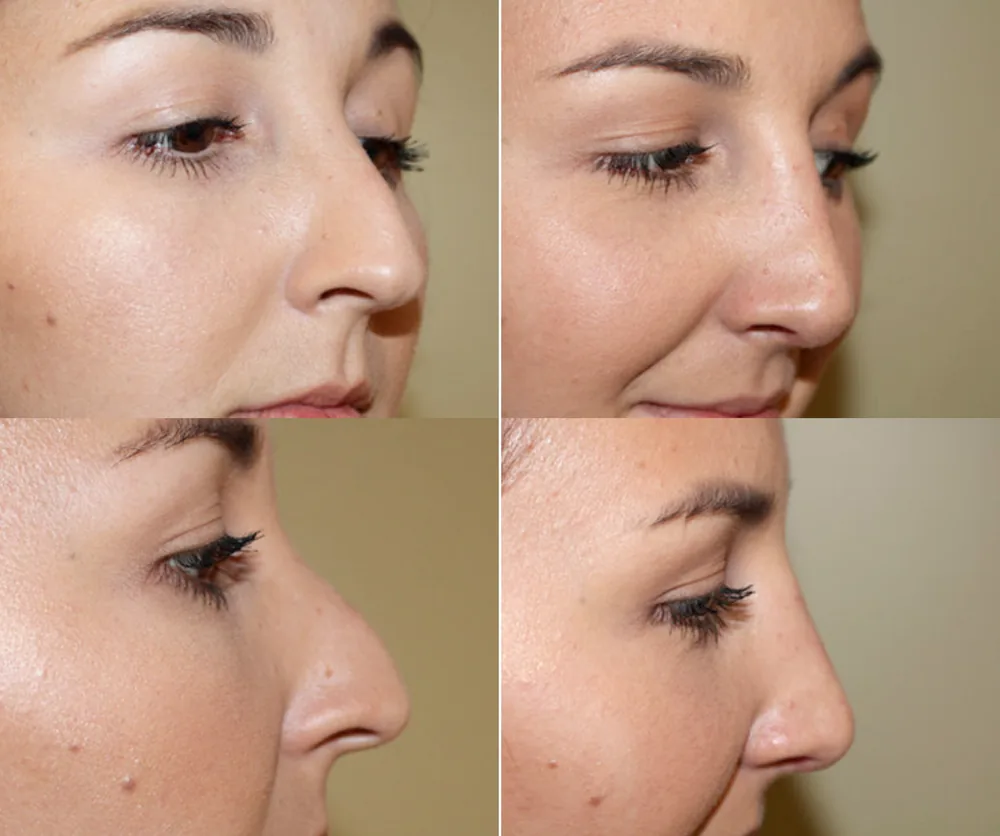RHINOPLASTY before-and-after result 2