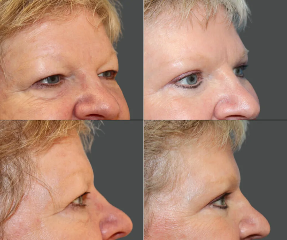 Eyelid Surgery Before & After result 5
