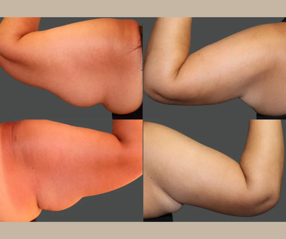 Arm Lift before-and-after result 2
