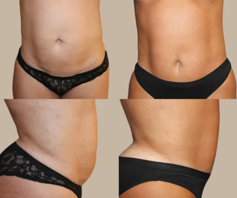 Results preview for mini tummy tuck