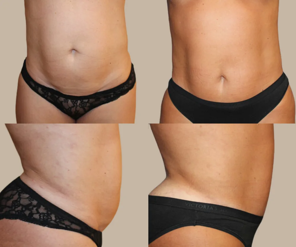 Mini Tummy Tuck Before & After result 1