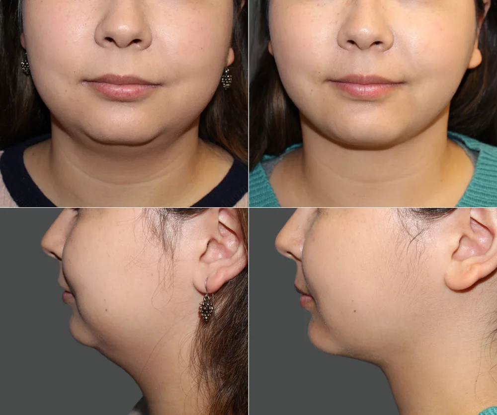 Neck Liposuction Before & After result 5