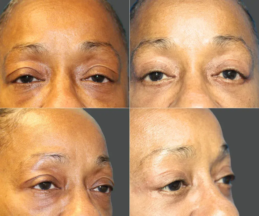 Eyelid Surgery Before & After result 8