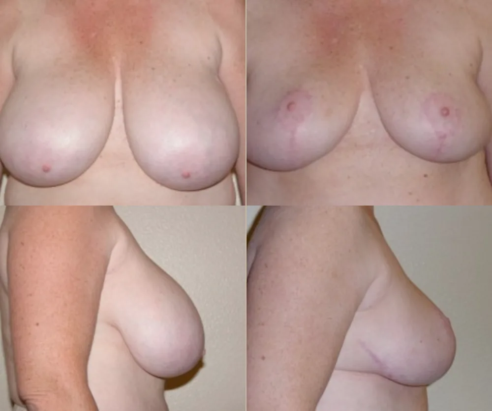 BREAST REDUCTION before-and-after result 3