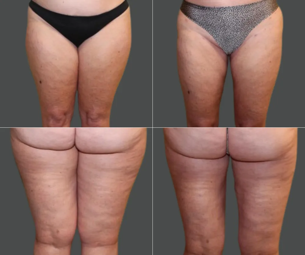 Liposuction before-and-after result 3