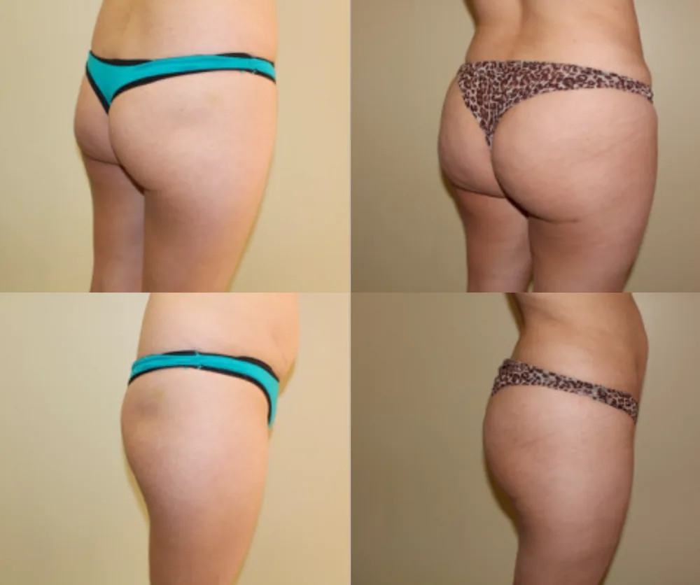Brazilian Butt Lift Before & After result 6