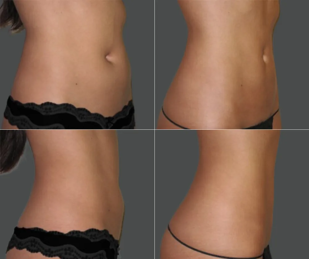 Liposuction Before & After result 6