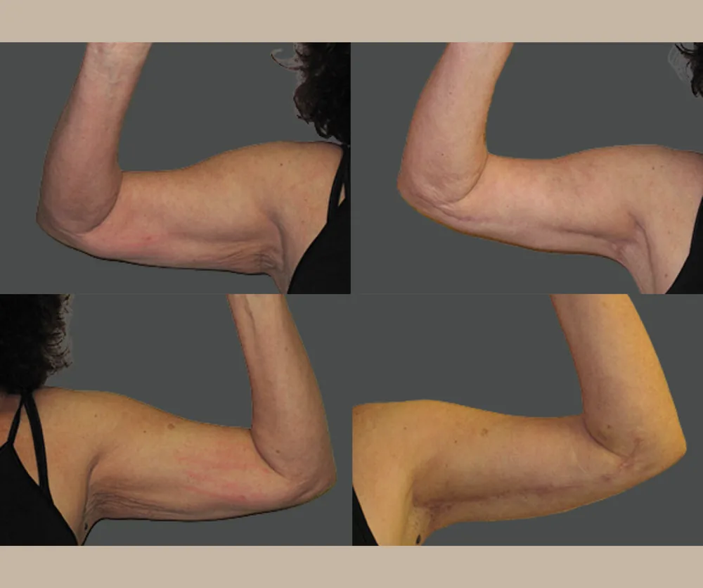 Arm Lift before-and-after result 1