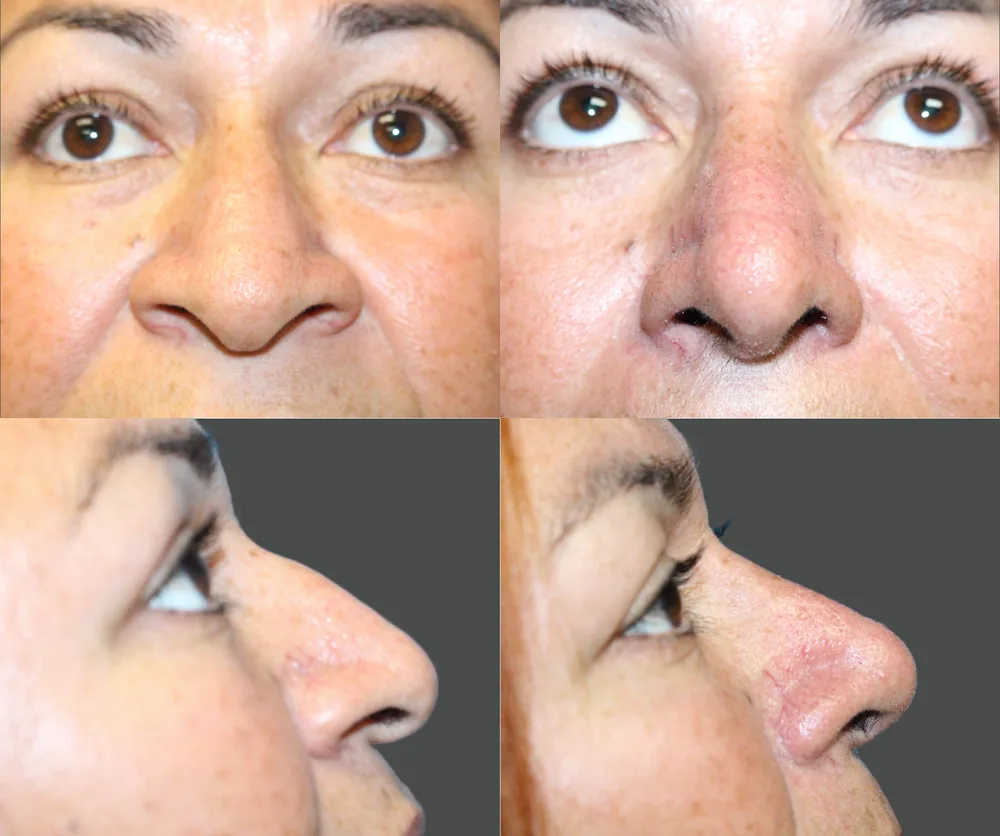 Rhinoplasty Before & After result 5