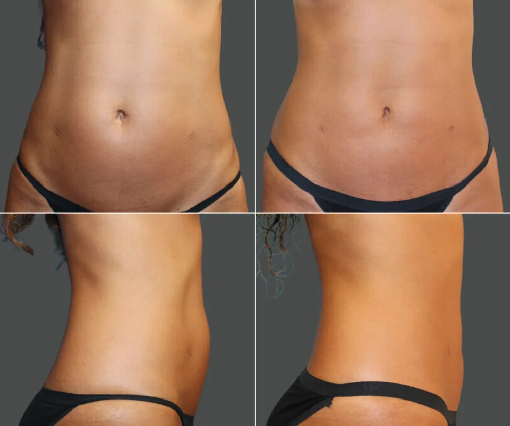 Liposuction before-and-after result 1