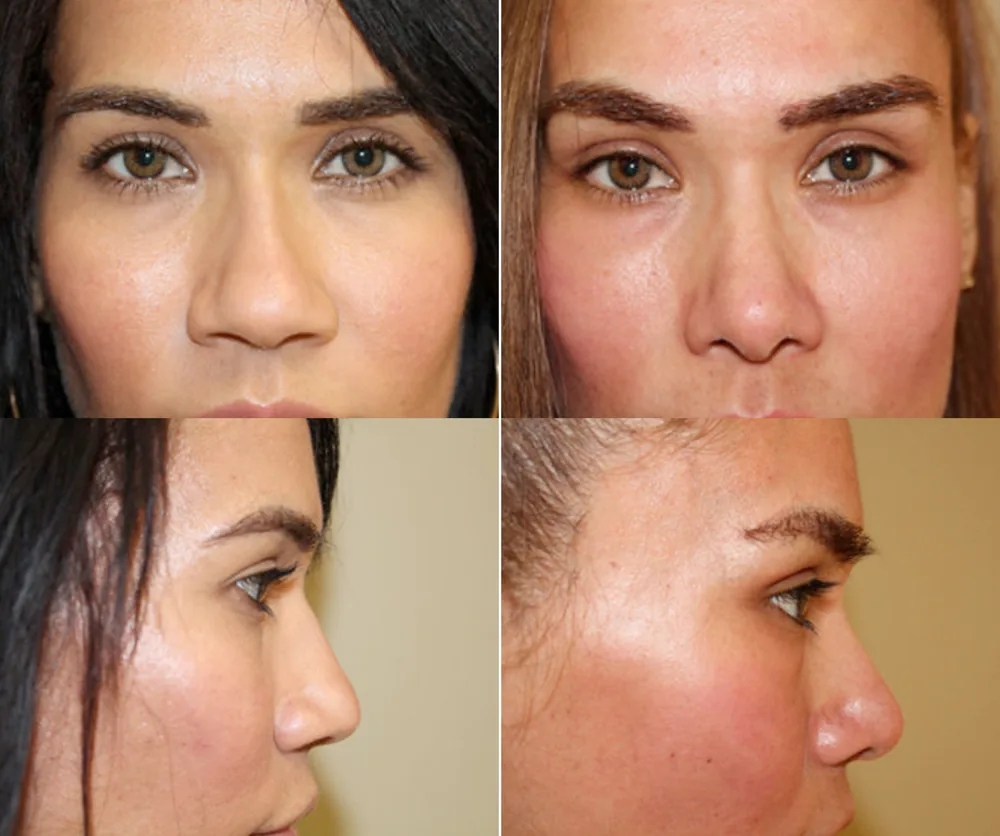 RHINOPLASTY before-and-after result 3
