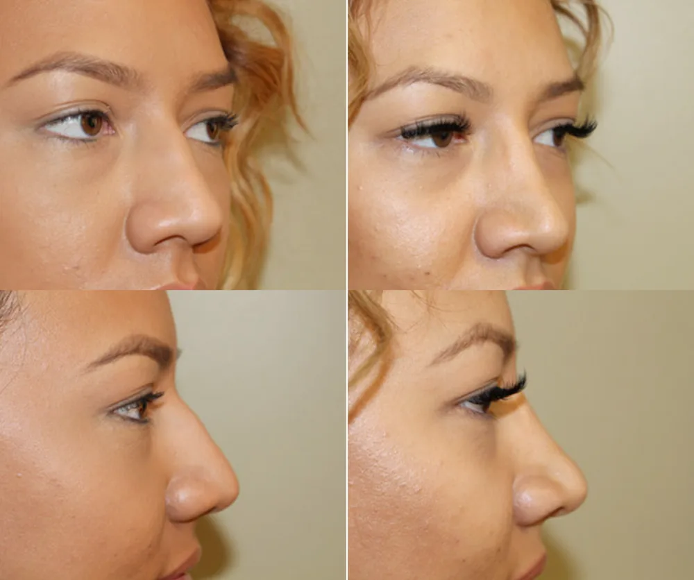 Rhinoplasty Before & After result 4