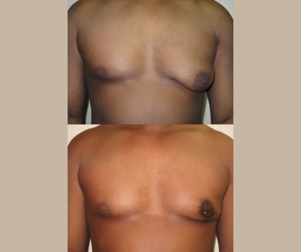 Male Breast Reduction Before & After result 5